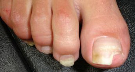 toe-nail-acrylics-34-16 Acrilici pentru unghii de la picioare