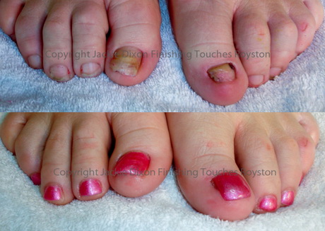 toe-nail-acrylics-34-3 Acrilici pentru unghii de la picioare