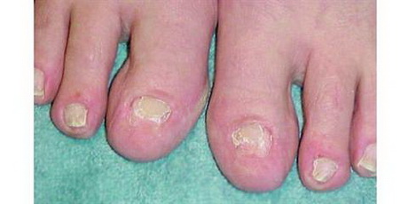 acrylic-toe-nail-21-2 Unghii de unghii acrilice