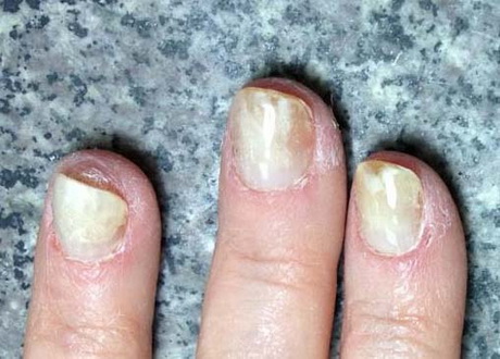 gel-nails-problems-48_10 Probleme cu unghiile cu Gel