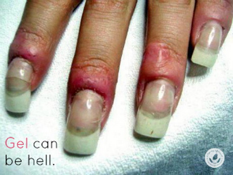 gel-nails-problems-48_11 Probleme cu unghiile cu Gel