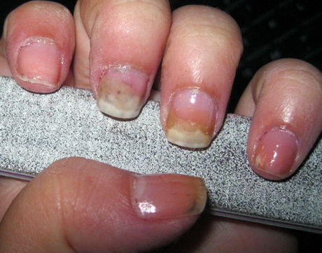 gel-nails-problems-48_9 Probleme cu unghiile cu Gel