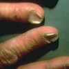 Probleme cu unghiile cu Gel